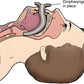 Medical illustration of Guedel Oral Airway in LINE2Design Airway Kit Color Coded