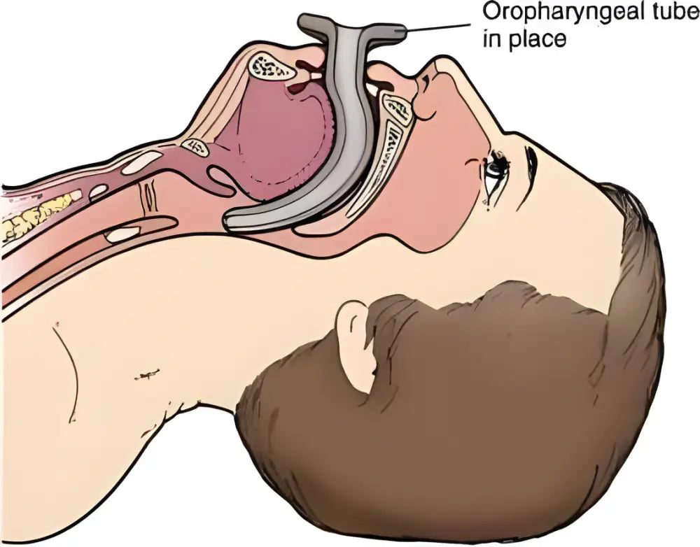 Medical illustration of Guedel Oral Airway in LINE2Design Airway Kit Color Coded